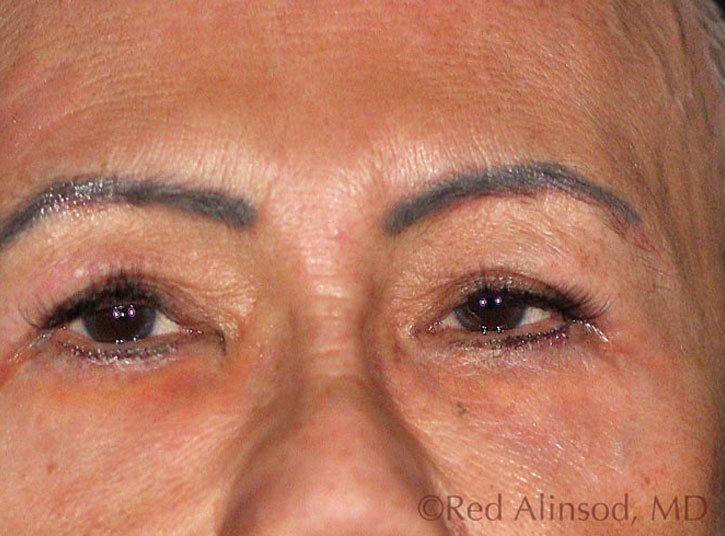 Pelleve RF Wrinkle Reduction System