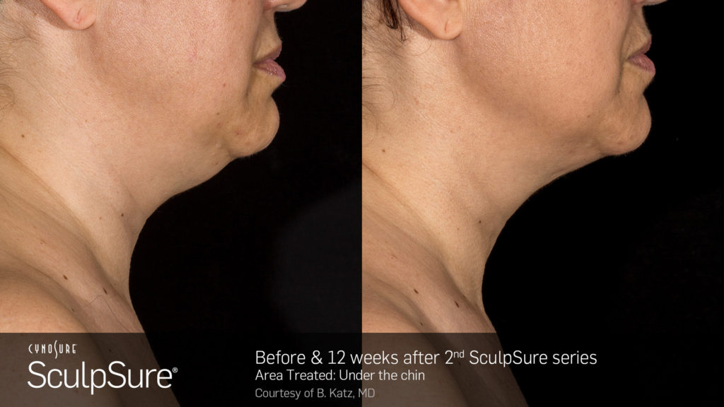 Sculpsure - Havertown Dermatologist